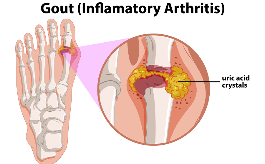 What is Gout