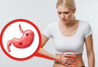 Stomach Ulcer
