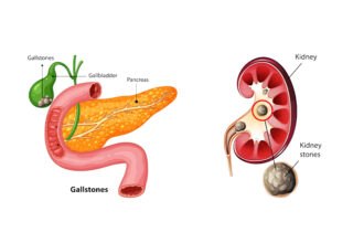 Gallstones Vs Kidney Stones