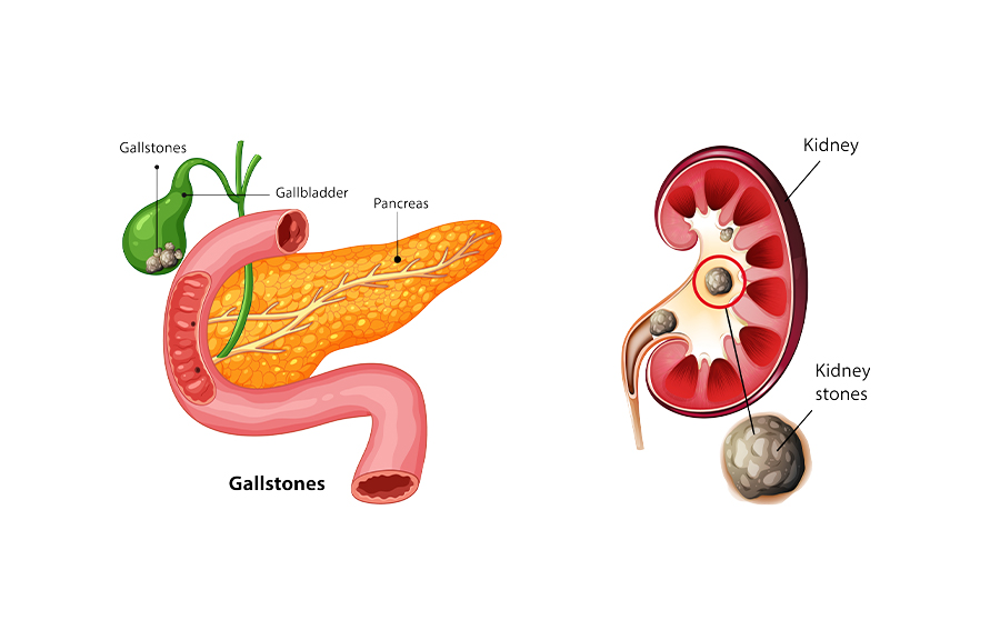 Gallstones Vs Kidney Stones
