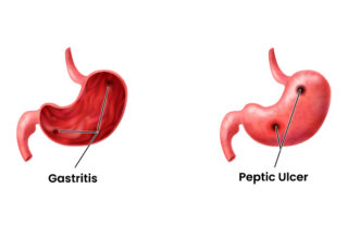 Gastritis vs Peptic Ulcer Disease