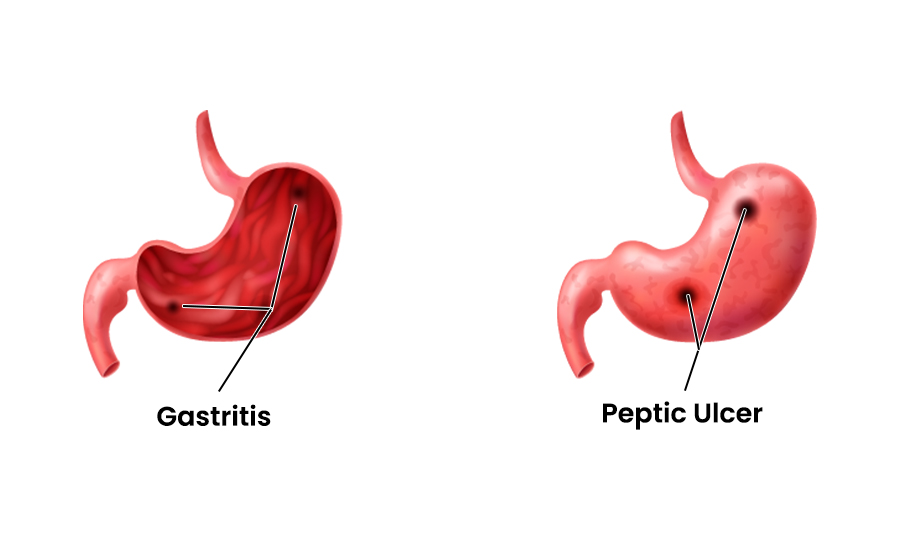 Gastritis vs Peptic Ulcer Disease