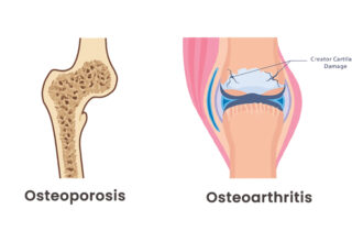 Osteoporosis Vs Osteoarthritis