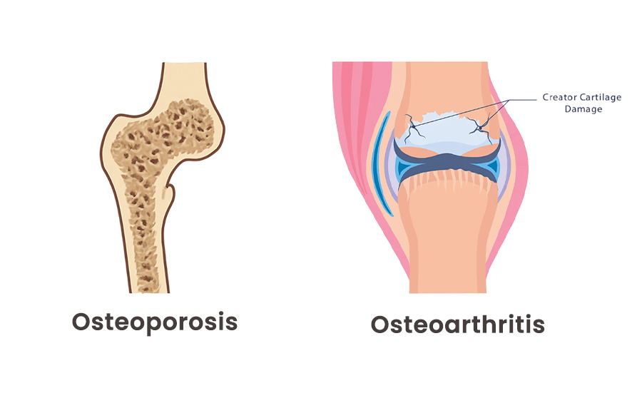 Osteoporosis Vs Osteoarthritis