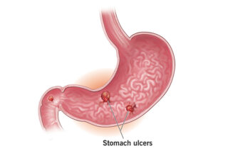 Stomach Ulcer