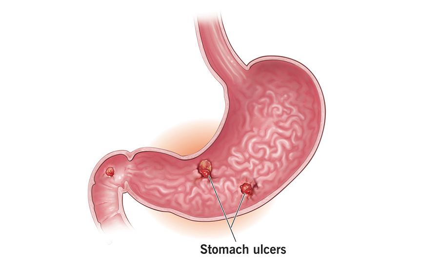 Stomach Ulcer