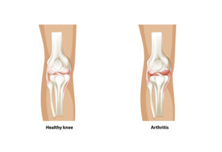 Arthritis Associated with IBD