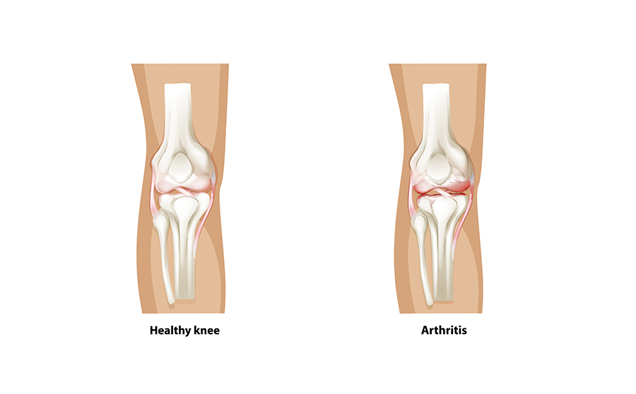 Arthritis Associated with IBD