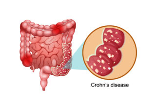 Diagnosis of crohns disease