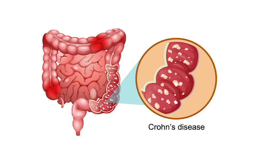 Diagnosis of crohns disease