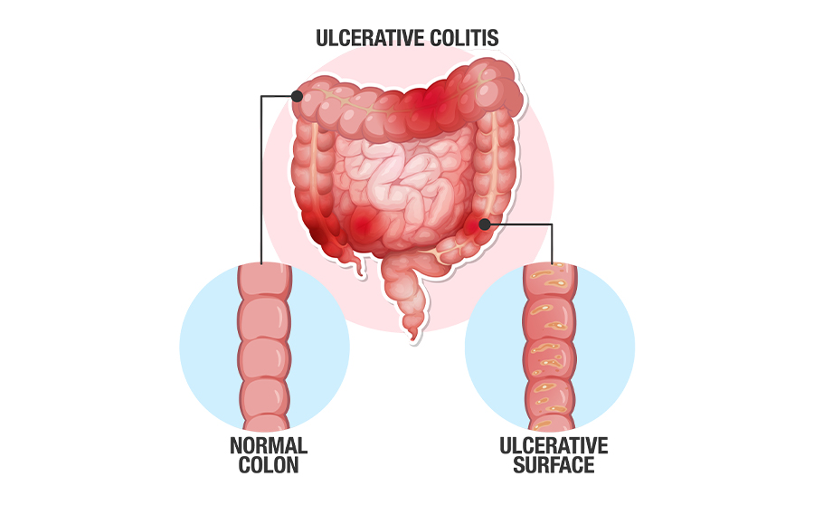 is ulcerative colitis contagious