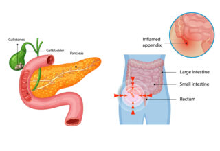 Gallbladder Pain vs Appendicitis