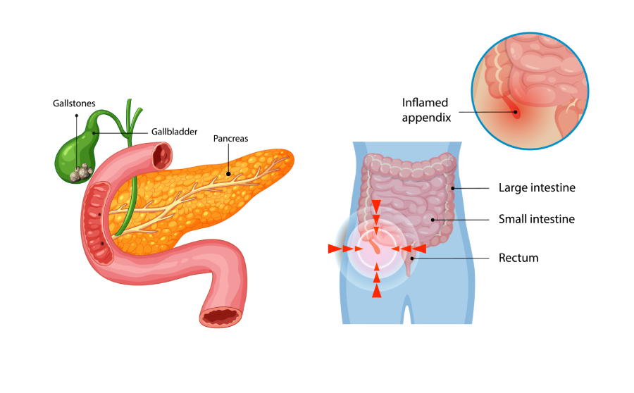 Gallbladder Pain vs Appendicitis