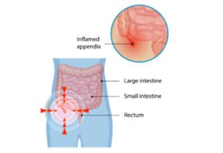 Appendicitis | Symptoms, Causes, Diagnosis & Treatment