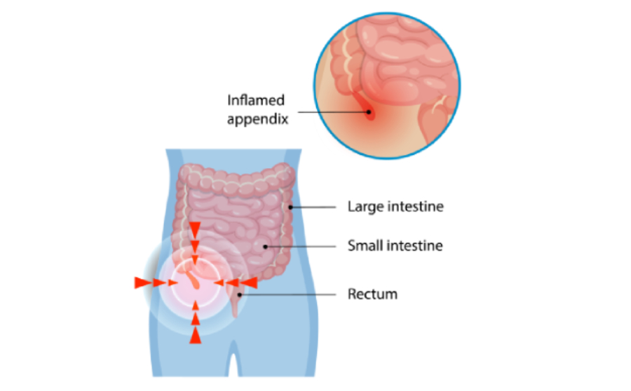 Appendicitis | Symptoms, Causes, Diagnosis & Treatment