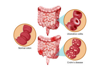 Crohn’s Disease vs Ulcerative Colitis | Similarities and Differences