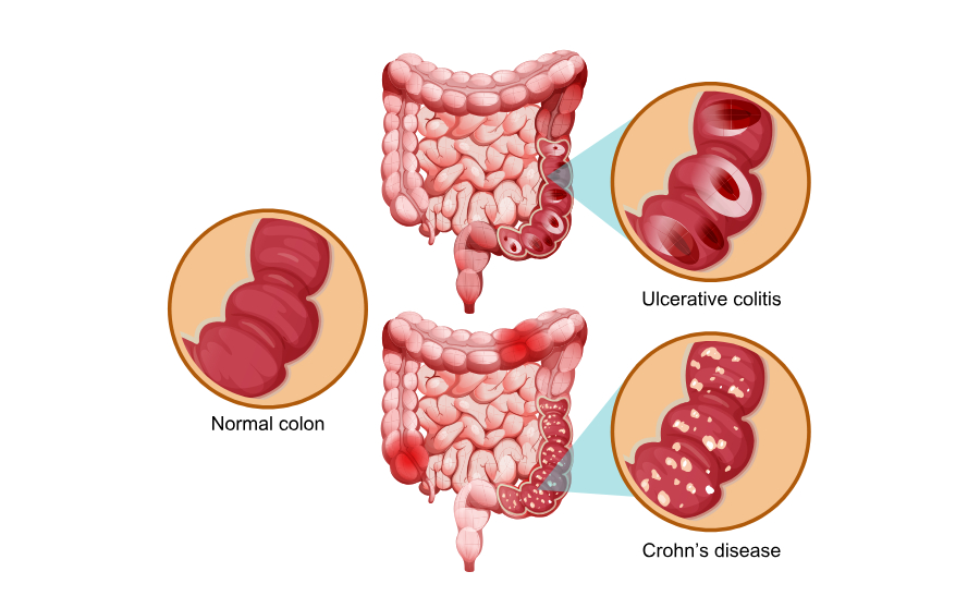 Crohn’s Disease vs Ulcerative Colitis | Similarities and Differences