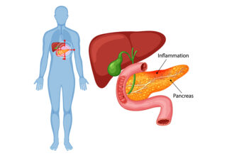 Management of pancreatitis