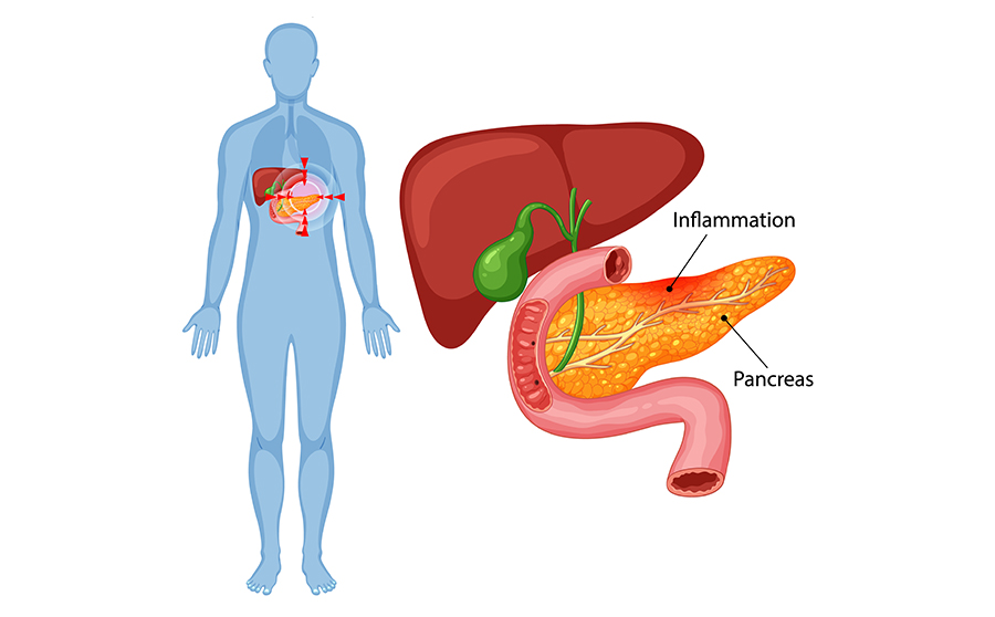 Management of pancreatitis