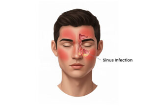 Sinus Infection